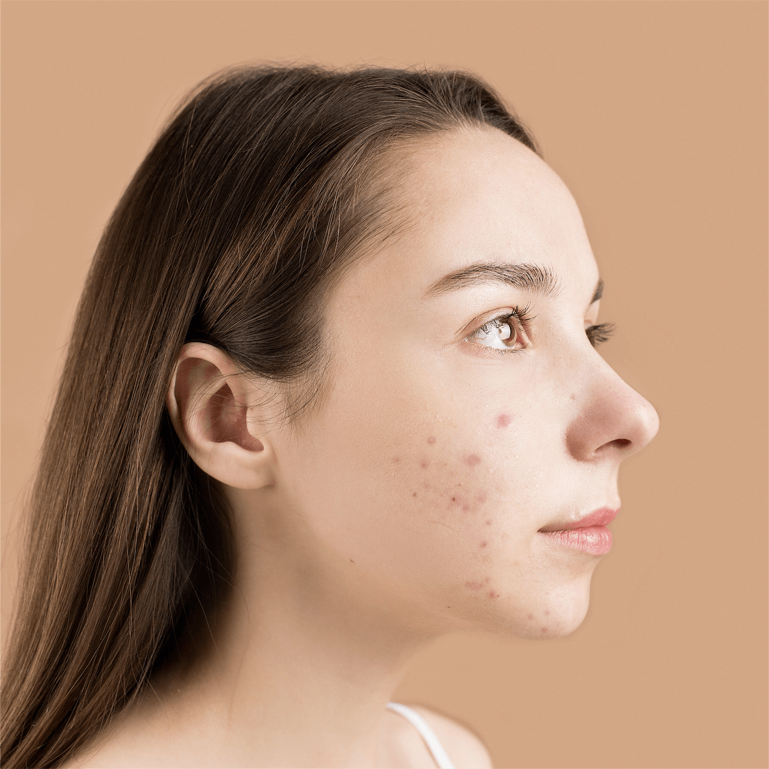 Acne Scars 101: How to Reduce Pimple Marks?