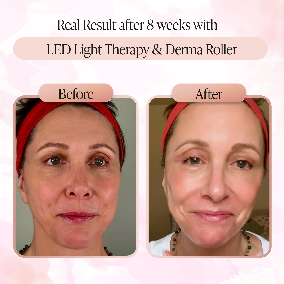 LED Light Therapy and Derma Roller