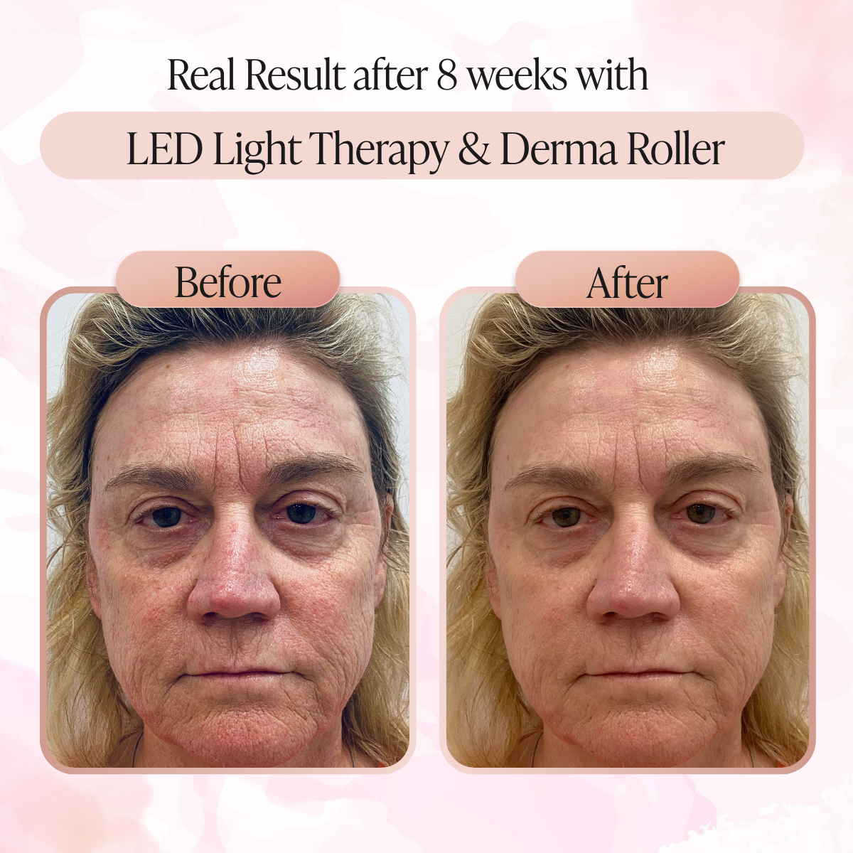 LED Light Therapy and Derma Roller