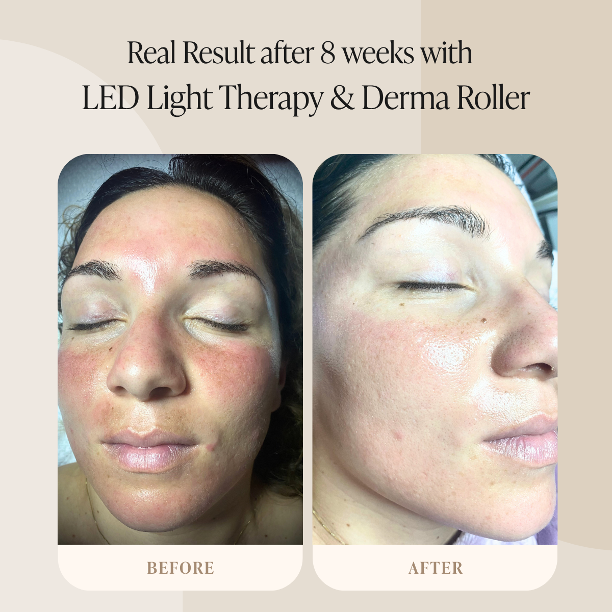 LED Light Therapy and Derma Roller
