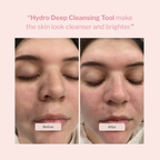 Hydro Blackhead Cleansing Facial Tool