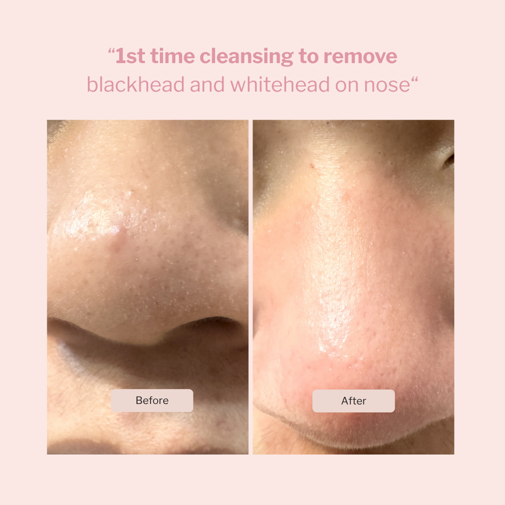 Hydro Blackhead Cleansing Facial Tool