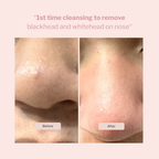 Hydro Blackhead Cleansing Facial Tool