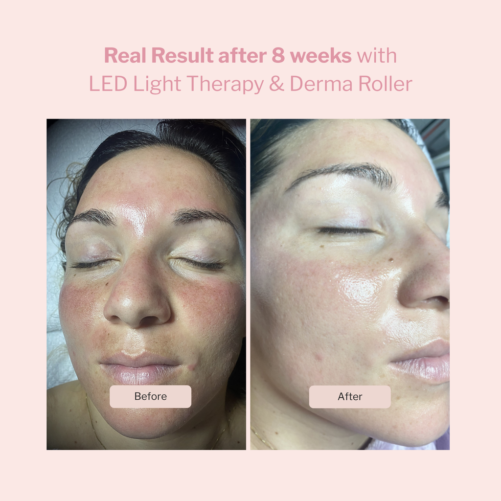 LED Light Therapy and Derma Roller