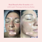 LED Light Therapy and Derma Roller