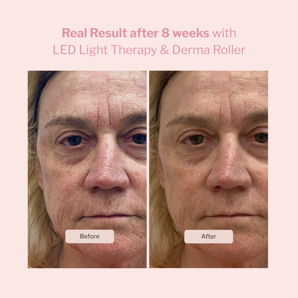LED Light Therapy and Derma Roller