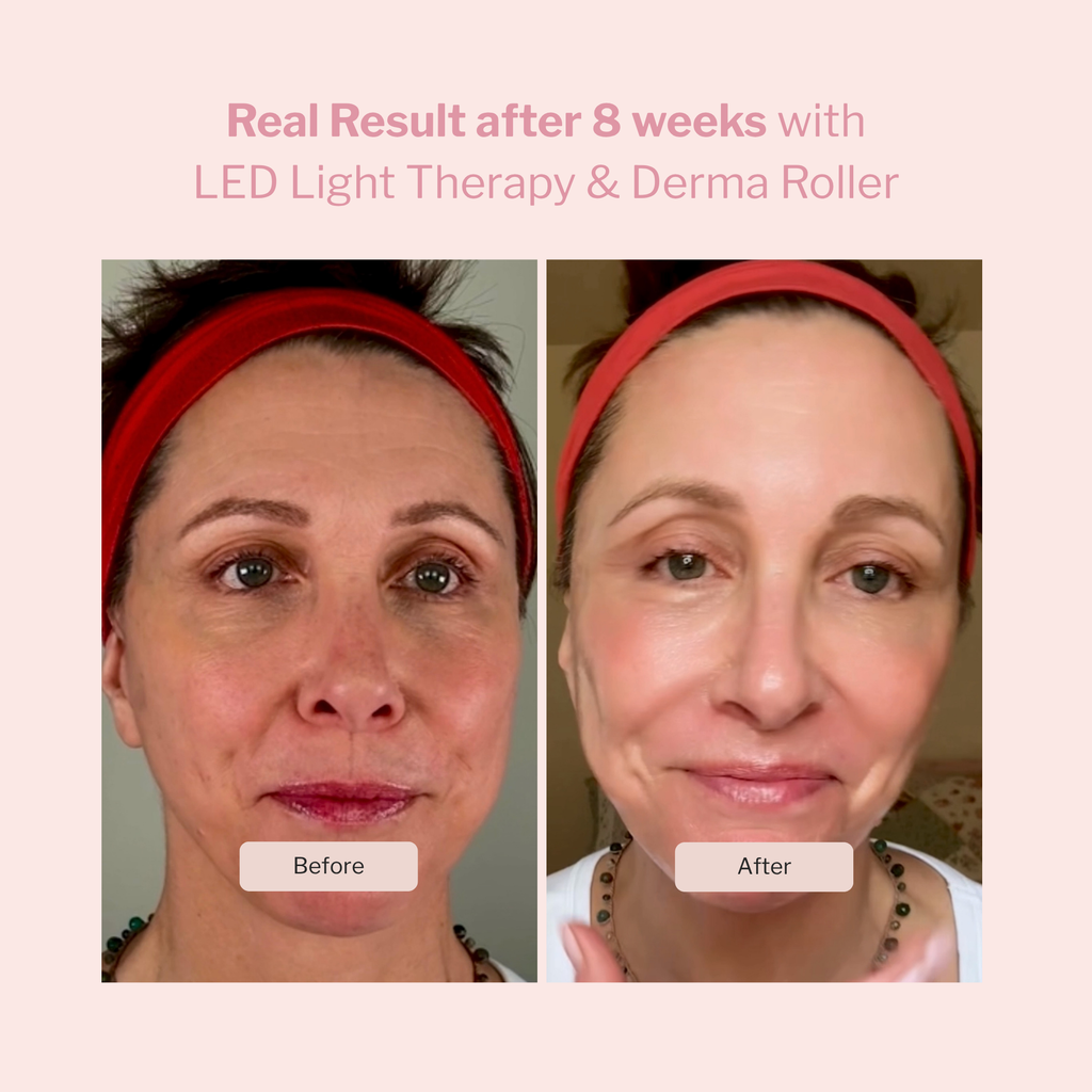 LED Light Therapy and Derma Roller