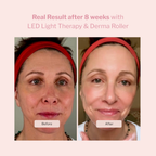 LED Light Therapy and Derma Roller