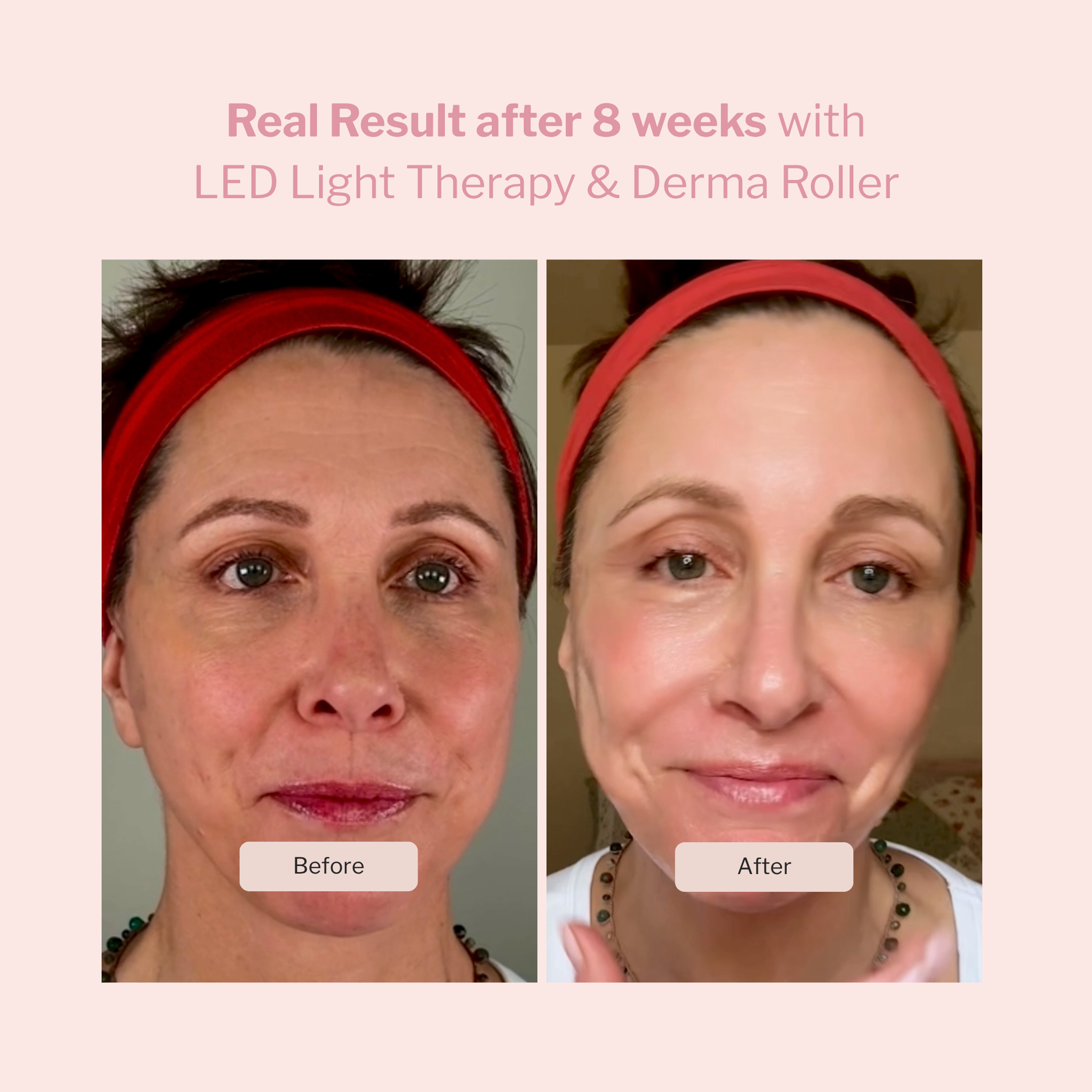 LED Light Therapy and Derma Roller